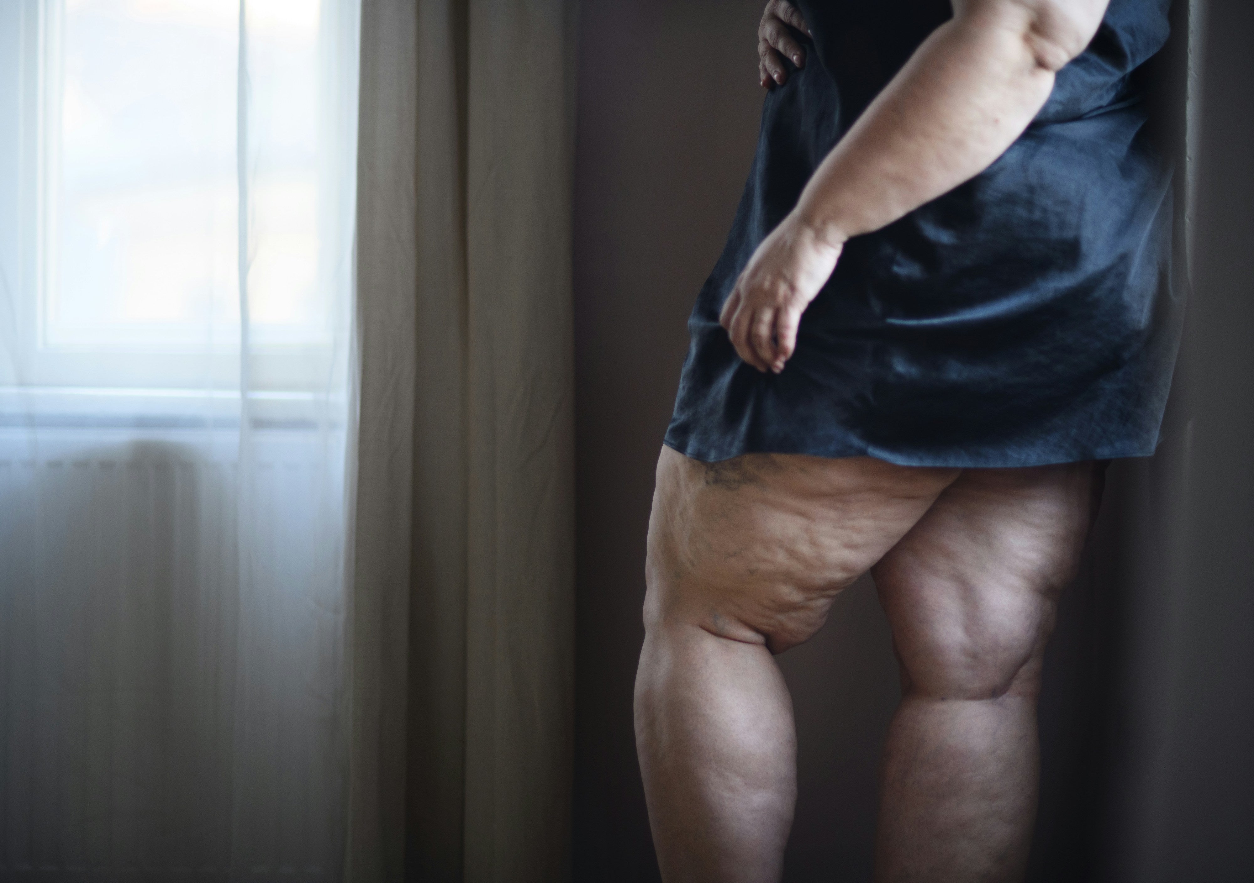Wassereinlagerungen und die Schilddrüse: Ursachen, Symptome und wichtige Tipps